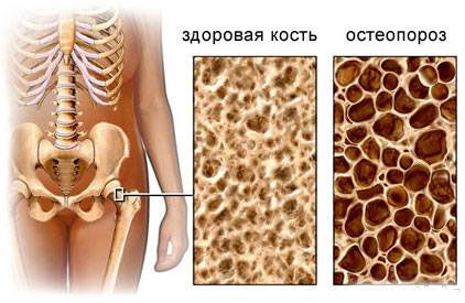остеопороз